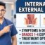 Internal vs External Piles